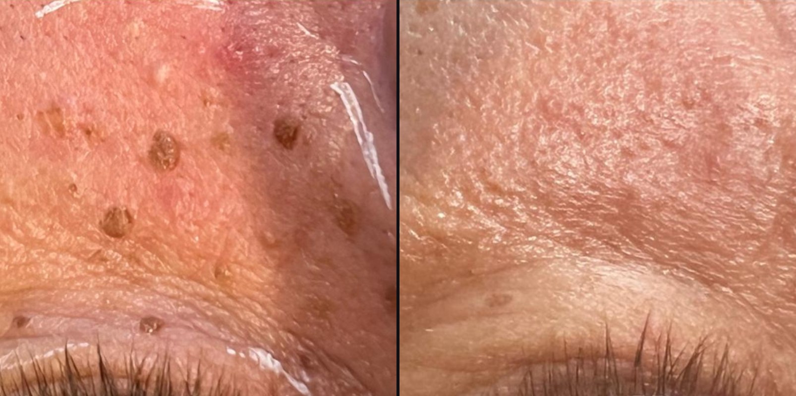 Before and after — Surface Refinement