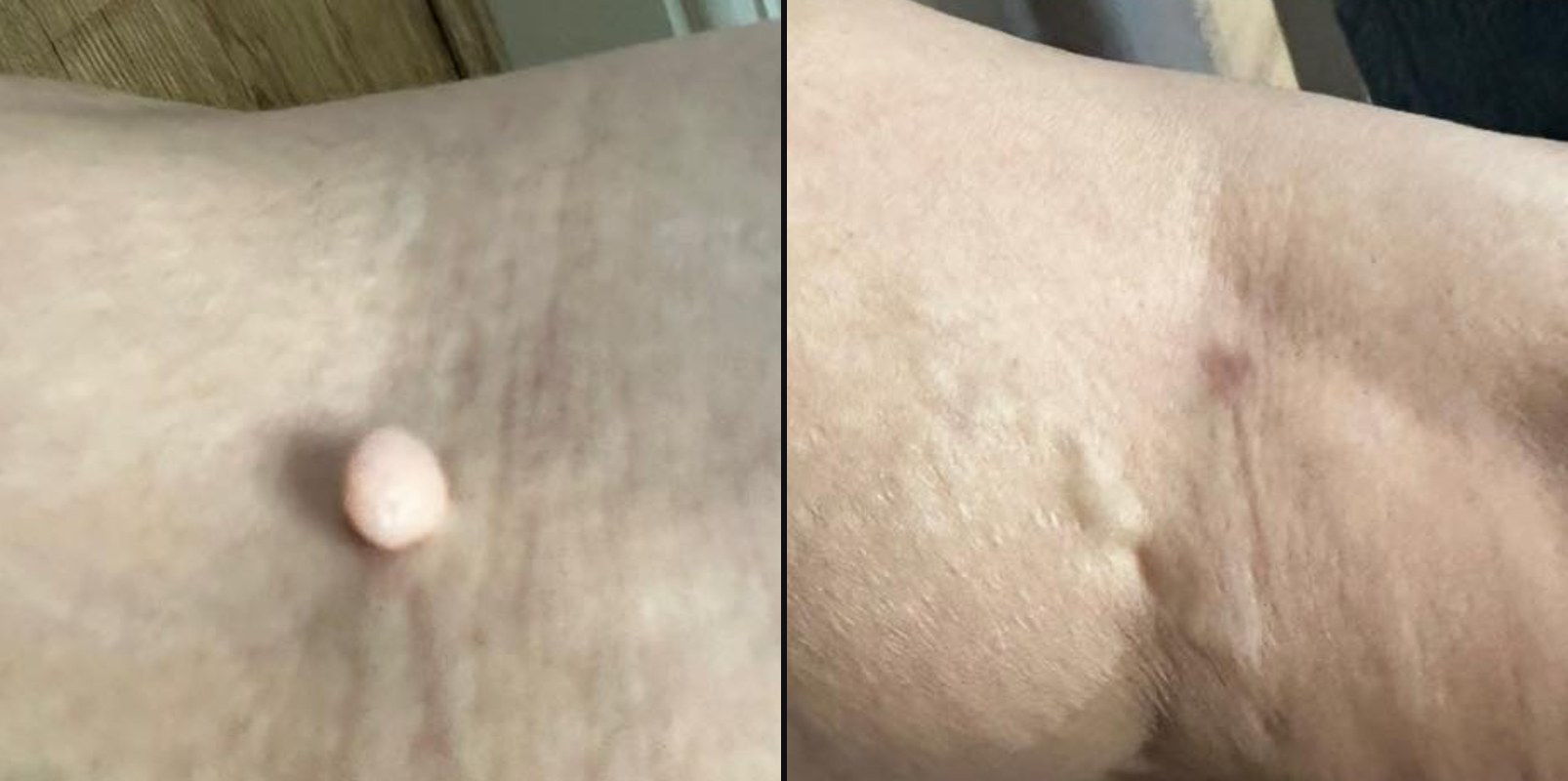 Before and after — Surface Refinement