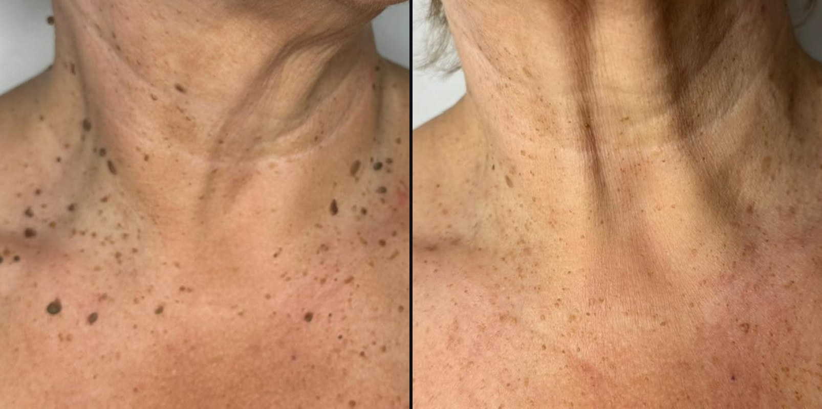 Before and after — Surface Refinement