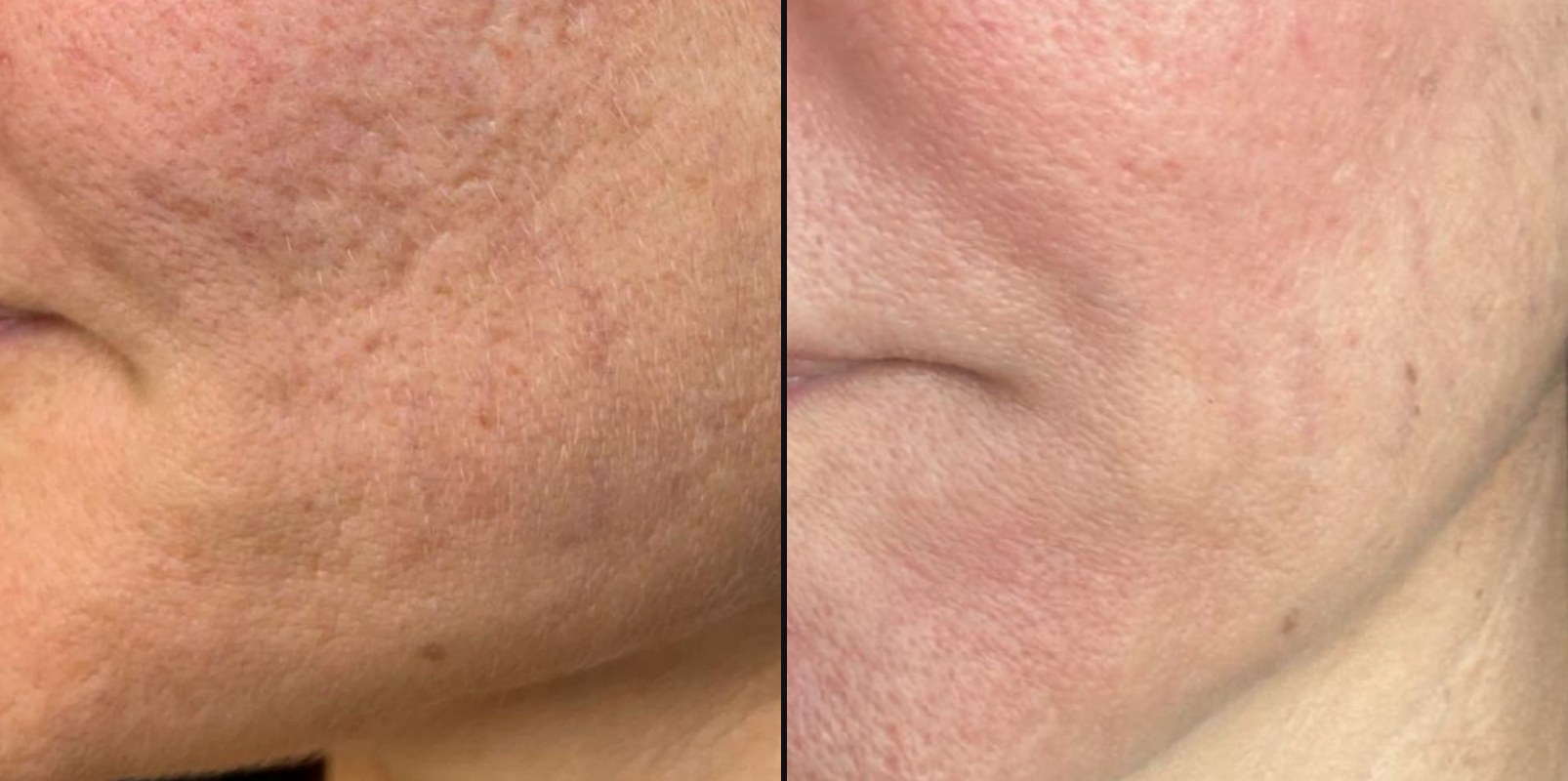 Before and after — Texture Smoothing